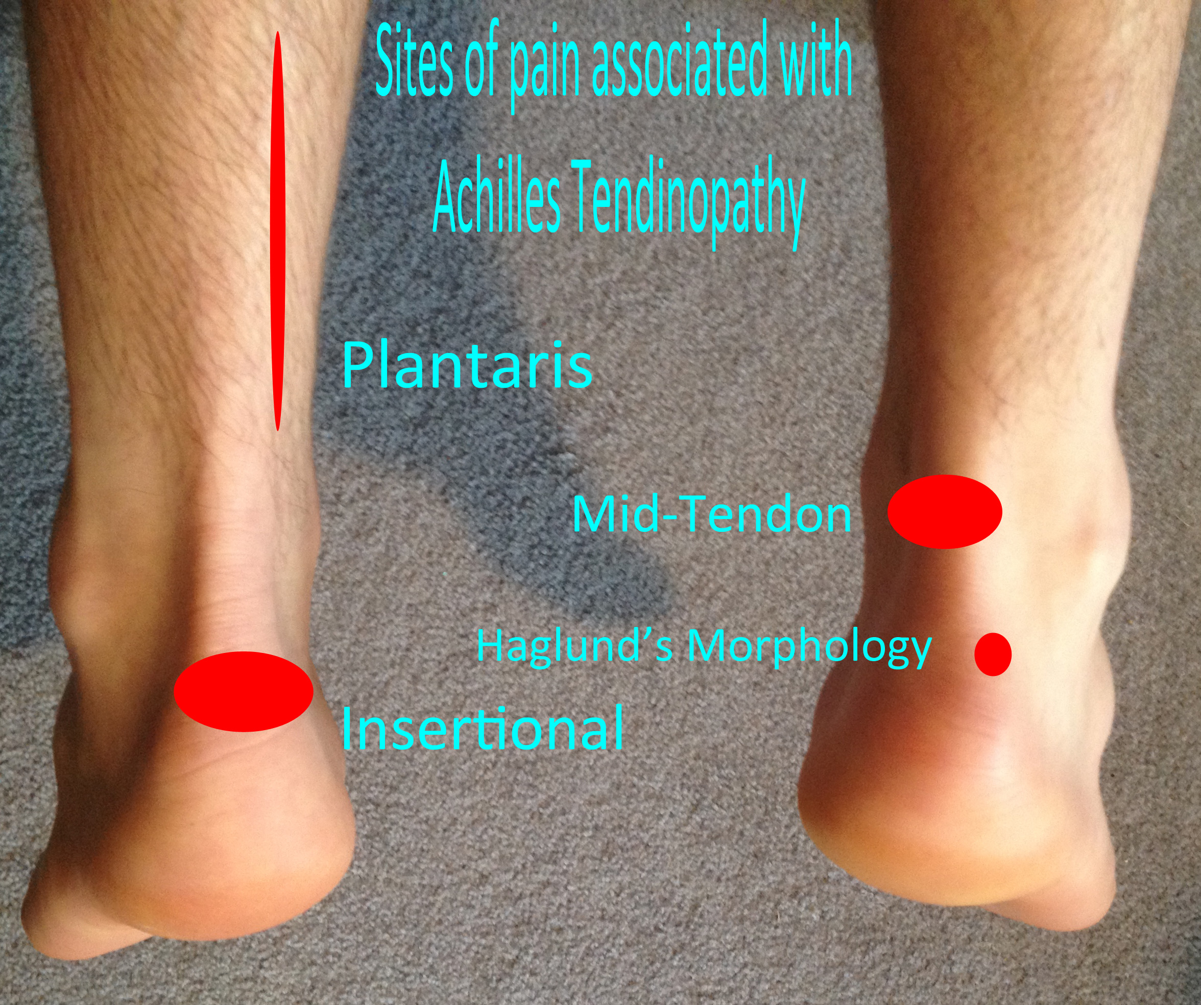 pain above heel of foot